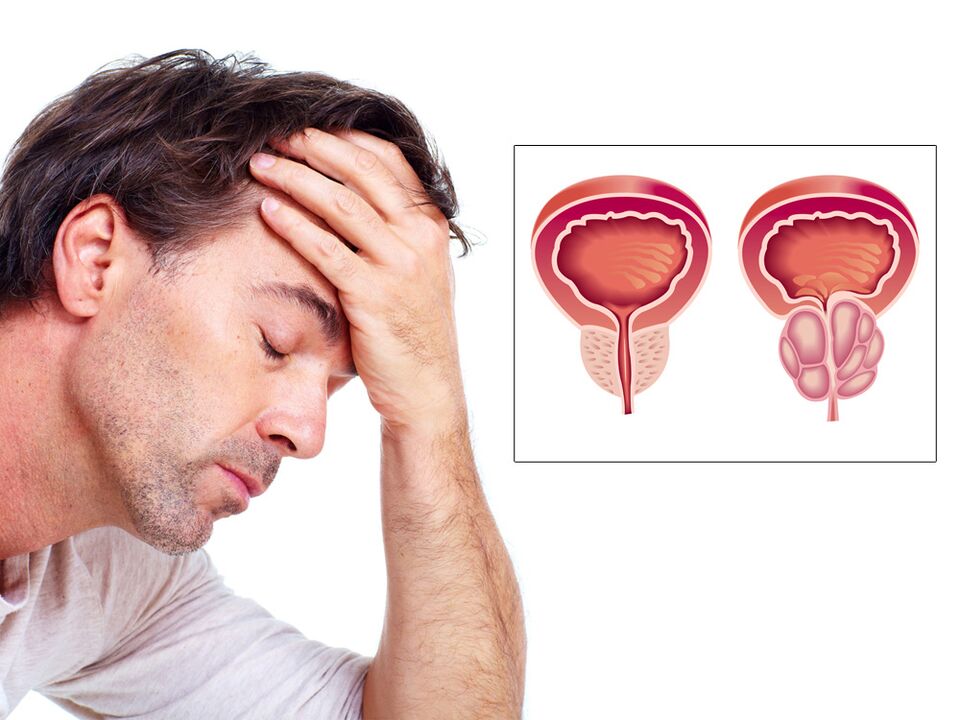adenoma e prostatës me impotencë