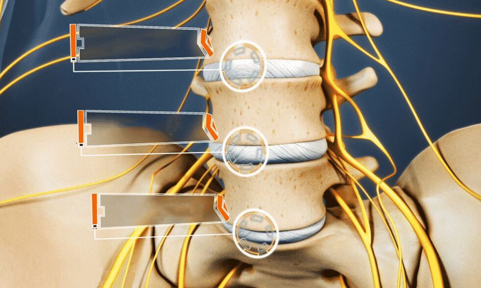 hernia ndërvertebrale çon në impotencë